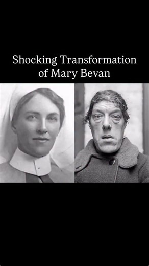 Mary Ann Bevan (1874 - 1933) was an English woman who toured the sideshow circuit as “the ugliest woman in the world” after her appearance drastically changed due to developing acromegaly. It leads to excess growth hormone which causes enlargement of the forehead, jaw, and nose. In the early 2000s, Bevan’s image was used by Hallmark Cards on a birthday card in the United Kingdom. The card made reference to the television dating show Blind Date. Subsequently, a complaint was made by a Dutch physi