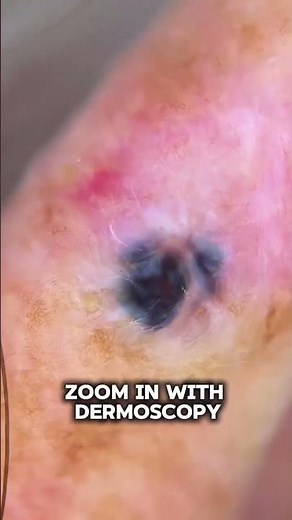 This pink and pigmented spot is not a melanoma