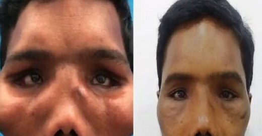 ‘Lion-faced’ man transformed after life-changing surgery – Watch video