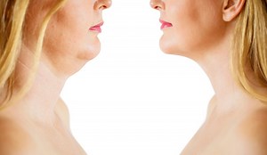 Double Chin Removal | Skin Works Medical Spa | Torrance, CA