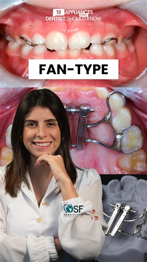 The star of the second episode of our series is the Fan-Type, or butterfly expander. 🪭🦋 It’s one of the most commonly used expanders in Interceptive Orthodontics. Unlike traditional expanders, it doesn't widen the posterior segment of the dental arch — it focuses only on the anterior region. This appliance has two specific indications in Orthodontics. Curious to find out what they are? 👉 Drop ‘APPLIANCES’ in the comments, and I’ll send the links to the next episodes straight to your DMs. Dr. 