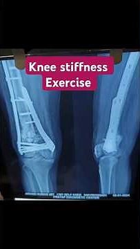 Knee stiffness physiotherapy/knee post operative exercise