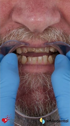 Fixing a 20-year underbite — NO surgery required! ✨🇬🇧➡️🇹🇷 #smilemakeover