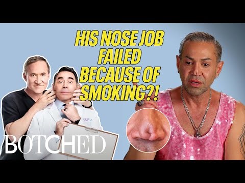 Robert’s Nose Job Failed Because He Smoked During Recovery (Before & After) | Botched | E!