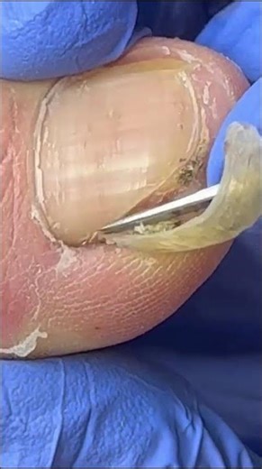 Professional Treatment For Paronychia