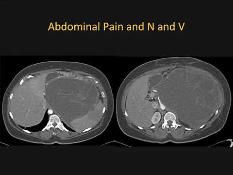Mucinous Cystic Neoplasm (MCN) of the Pancreas: What You Need to Know – Part 2