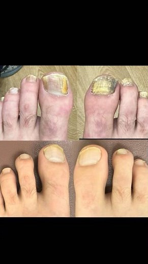 How to Cure TOENAIL FUNGUS! #shorts