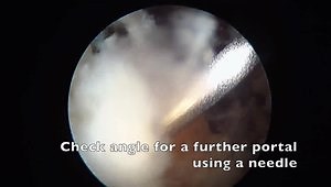 Arthroscopic double row rotator cuff repair using Stryker Iconix and ReelX anchors