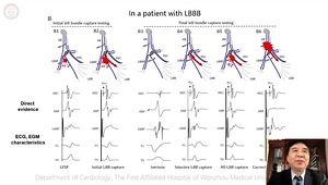 LB Pacing- Huang 2 - Lead Technique and Defining Conduction System Capture