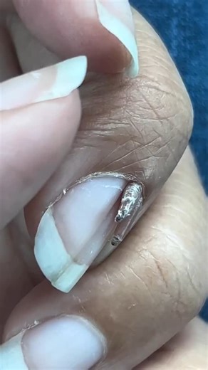 MedWorld- Medical & Health on Instagram: "A cutaneous horn is a hard, cone-shaped growth made of keratin (the same protein found in nails and hair) that projects above the surface of the skin — like a tiny horn. It’s not a disease itself, but a reaction of the skin to various underlying conditions. It usually forms when the skin produces excess keratin. This information is for educational purposes only and is not a substitute for professional medical advice. Consult a healthcare provider for per