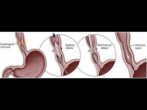 Balloon dilation in Surgery Technique ; Esophageal dilation, Balloon angioplasty, Ureteral dilation