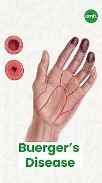 Did You Know? Buerger’s Disease: An Unique Disease Of Fingers & Toes!