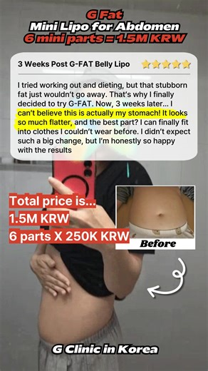🔥 3 Weeks After G-FAT Belly Lipo 🔥 “I can’t believe this is actually my stomach! It looks so much flatter and the best part? I can finally fit into clothes I couldn’t wear before!” ✨ Stubborn belly fat gone. ✨ Visible results in just 3 weeks. ✨ Mini Lipo for abdomen – 6 mini parts = 1.5M KRW (~$1,100) ➡️ Say goodbye to stubborn belly fat and hello to confidence. DM us to book your consultation today! #GFAT #MiniLipo #AbdomenLipo #BeforeAndAfter #FlatTummy