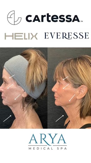 Treating clients with multiple modalities is one of our favorite things to do at ARYA — because great skin deserves a comprehensive approach! Cortney shares how pairing the Cartessa Helix and Cartessa Everesse allows us to treat different layers of the skin for refined texture, improved tone, and deeper collagen remodeling! Visit aryamedspa.com to learn more and book your appointment today! | Arya Med Spa