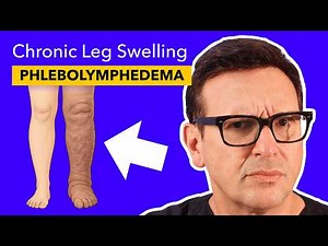 Phlebolymphedema: The Hidden Cause of Chronic Leg Swelling