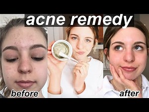 How to Get Rid of Acne | Teen Skin Care Routine