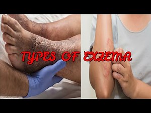 7 TYPES OF ECZEMA YOU NEED TO KNOW