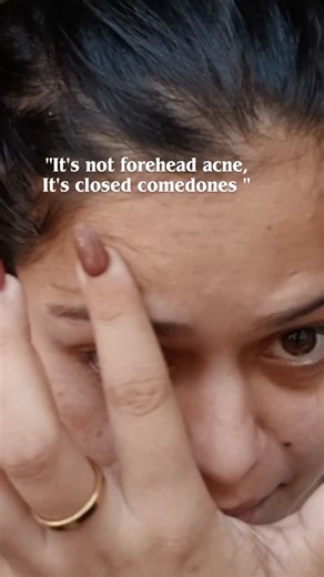 Tannu Tannu on Instagram: "Let me explain to you....... ✅ Types of Comedones 1️⃣ Open Comedones (Blackheads) Pore is open. Looks dark because oil + dead skin oxidizes (not dirt). 2️⃣ Closed Comedones (Whiteheads) Pore is closed with a thin skin layer. Small, white/flesh-colored bumps. Common on forehead, cheeks, chin. --- ✅ Why Comedones Form ✔ Excess oil (sebum) ✔ Dead skin buildup ✔ Comedogenic products (heavy oils, thick makeup) ✔ Hormonal imbalance ✔ Not cleansing properly ✔ Sweat + pollutio