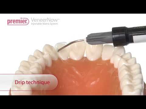 VeneerNow™ Injectable Matrix System - Restoration of Peg laterals