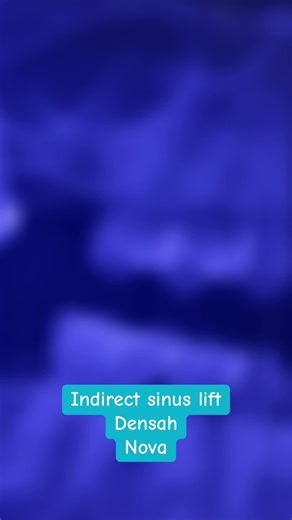 Indirect Sinus Lift Using Densah Bur Techniques