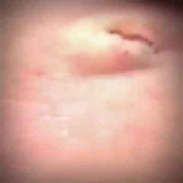 dr pimple popper 2017