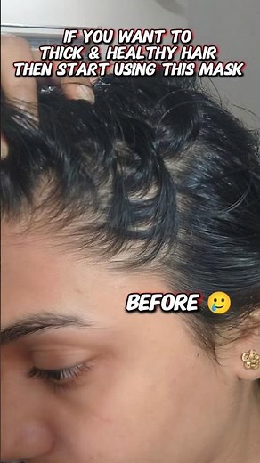 I was Going Bald 😭 But this saved my Hair ✨#Hairthinning#haircare #hairfallsoultion#hairgrowth #diy