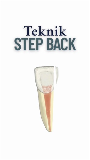 Keuntungan dan Kekurangan Teknik Step Back dalam Endodontik