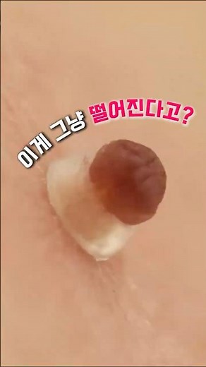 집에서 간편하게 쥐젖 제거하는법 #쥐젖제거기 #쥐젖 #피부관리 #홈케어