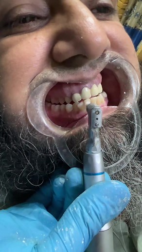 Teeth polishing process #foryou #standwithkashmir #dentalhygienist #dentistry #viewsproblem🥺 #viralvideo #foryoupage #viralvideo #viral #