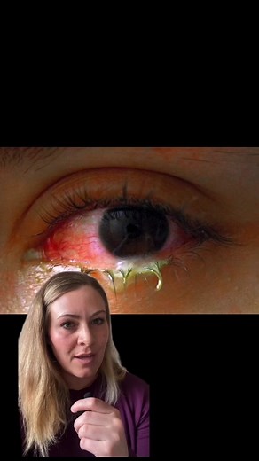 Types of Pink Eye in Children: Bacterial, Viral, and Allergic