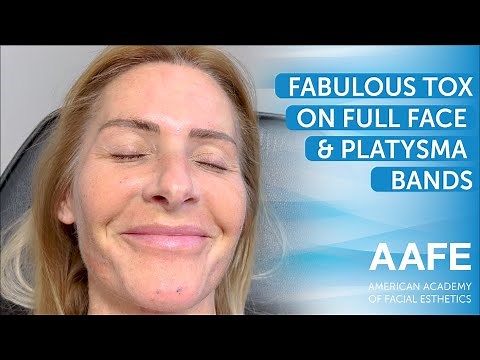 Fabulous Tox on Full Face & Platysma Bands