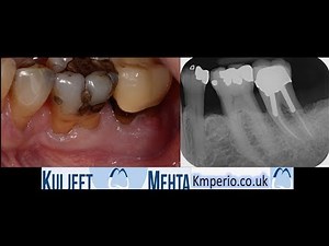 Extraction and Socket Grafting