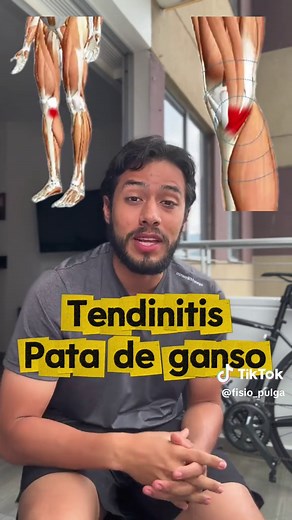 Identificando la Tendinopatía de la Pata de Ganso