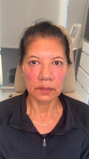 As we age, it’s normal to lose volume in the under-eye area and cheeks, which can make the face look tired or hollow. With precise dermal filler placement, we can restore that lost volume, brighten the under-eye area, and gently lift the cheeks for a refreshed, natural appearance. ✨ The goal is subtle rejuvenation — enhancing your features without changing who you are. Perfect for: • Hollow tear troughs • Flattened or sagging cheeks • A tired or aged look Results are immediate, and the effect ca