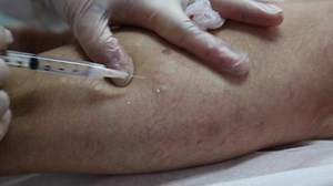 Spider Veins Removal with Sclerotherapy