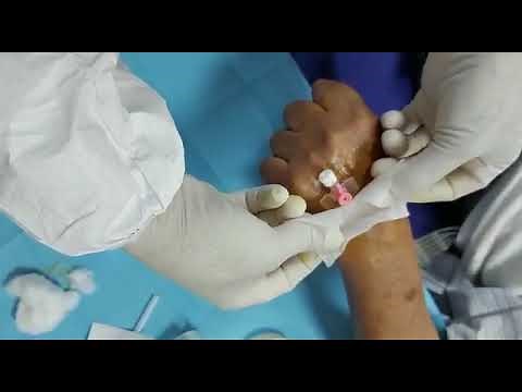 Prélèvement sanguin sous vide à travers une voie veineuse périphérique : technique