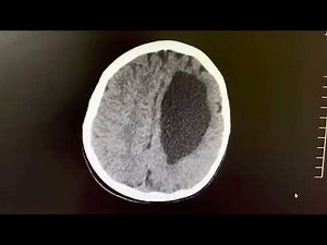 Porencephalic Cyst Brain CT scan