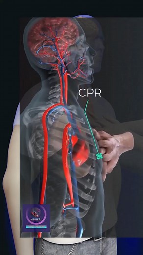 CPR, or Cardiopulmonary Resuscitation, is a life-saving technique used in emergencies | Medical Animation Media
