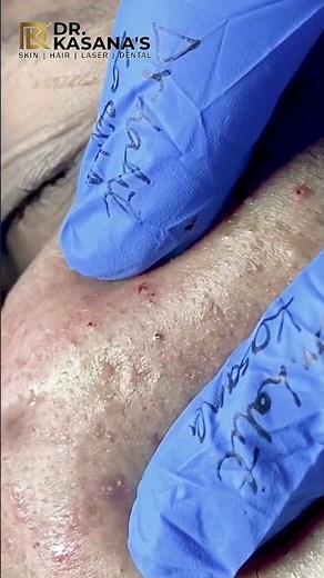 BLACKHEADS REMOVAL WITH INGROWN HAIR by DR.LALIT KASANA