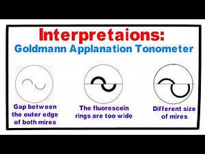 Interpretations- Goldmann Applanation Tonometer.