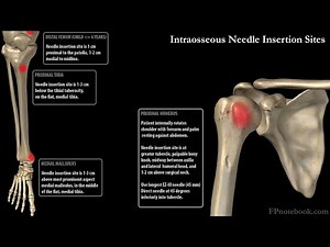 Practical anatomical techniques for intraosseous line placement