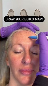 Draw Your Botox Map