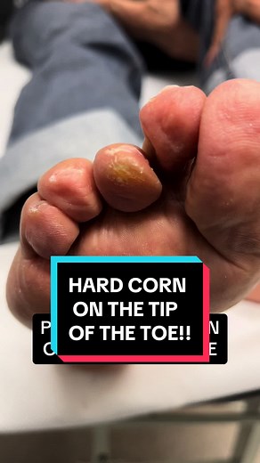 Effective Corn Removal Techniques by Podiatrists