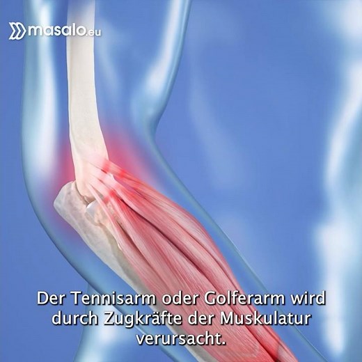 Ärzte und Anwender testen die Masalo Manschette gegen Tennisarm, Golferarm (Epicondylitis)