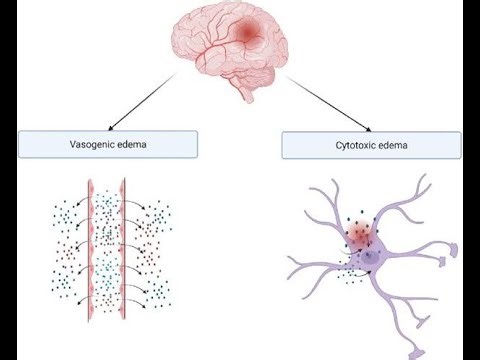 vasogenic And cytotoxic Cerebral edema; swelling in the brain caused by an accumulation of fluid