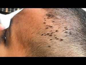 Cleaning The Big Lice On The Short Head - So Big Lice