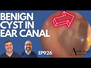 BENIGN EAR CYST IN EAR CANAL - EP926