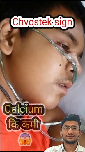 Chvostekʼs Sign 😱 Hypocalcemia.... #hypocalcemia#shorts#pregnancy #Muscletwitching #shortvideo