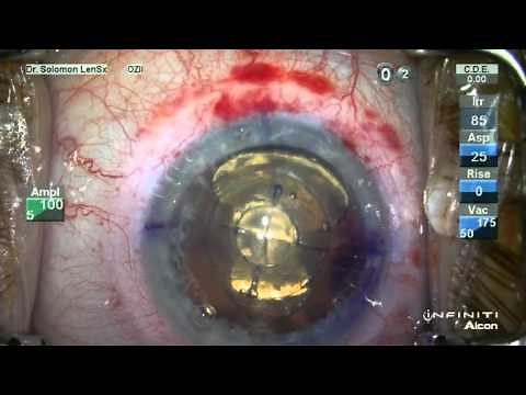 Watch LenSx Laser Cataract Surgery Performed by Dr. Kerry Solomon
