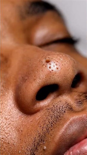 Insanely Satisfying ASMR Suction Extractions | Blackheads & Whitehead